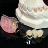 Custom Implant-Supported Hybrid Prostheses for Full-Arch Restoration