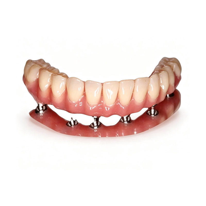 Custom Implant Bridge Frameworks & Screws for Implant Restorations