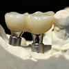 Custom Abutments & Screws