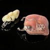 Custom Implant-Supported Hybrid Prostheses for Full-Arch Restoration