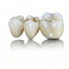 Custom Fixed Dental Prostheses – Crowns & Bridges
