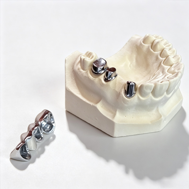 Custom Implant-Supported Hybrid Prostheses for Full-Arch Restoration